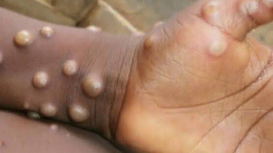 Health officials investigating suspected Mpox cases in Korinya, Konshisha Local Government Area of Benue State.
